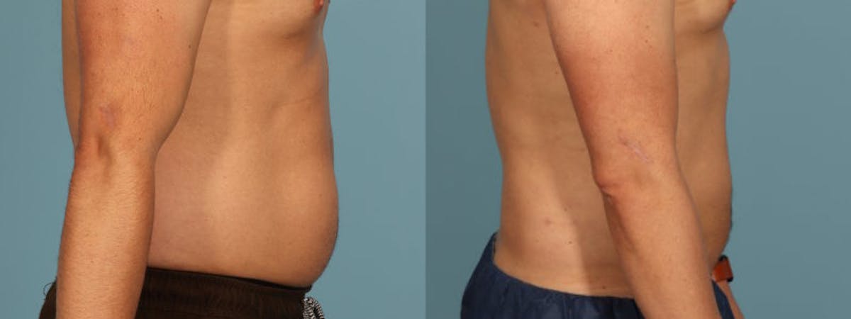 Liposuction Before & After Gallery - Patient 340300 - Image 5
