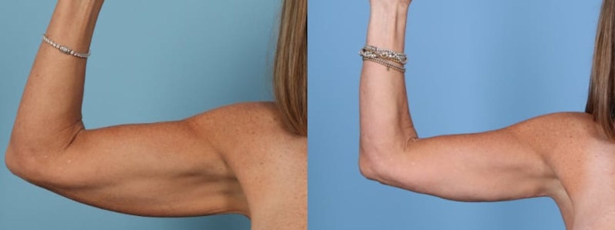 Arm Lift (Brachioplasty) Before & After Gallery - Patient 162565 - Image 1