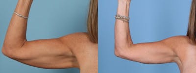 Arm Lift (Brachioplasty) Before & After Gallery - Patient 162565 - Image 1