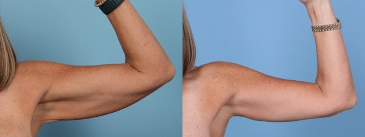 Arm Lift (Brachioplasty) Before & After Gallery - Patient 162565 - Image 2