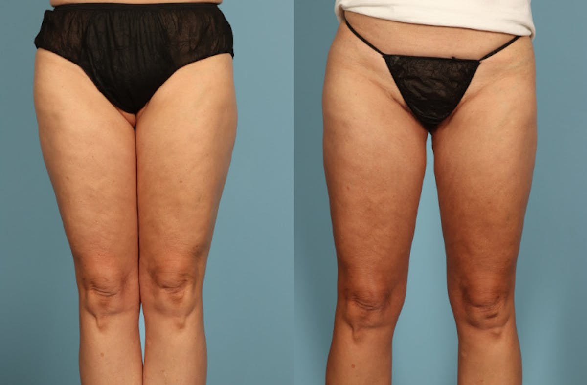 Thigh Lift Before & After Gallery - Patient 237274 - Image 1