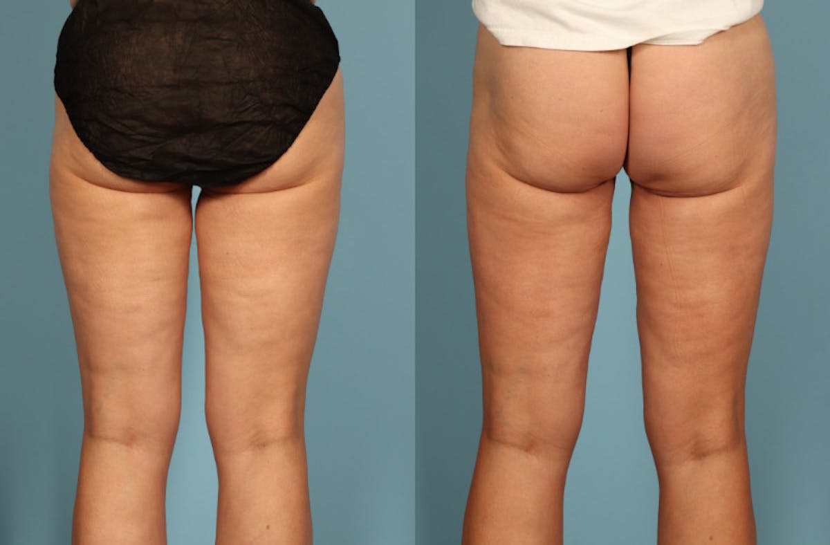 Thigh Lift Before & After Gallery - Patient 237274 - Image 2