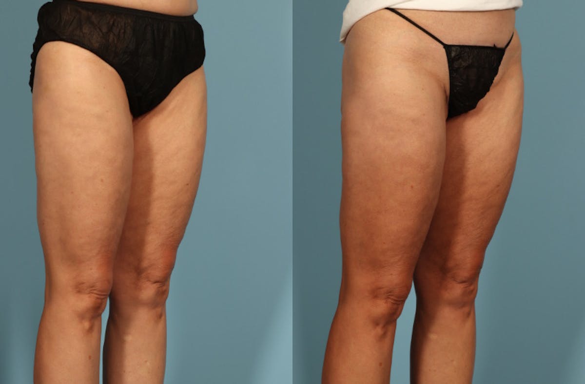 Thigh Lift Before & After Gallery - Patient 237274 - Image 3
