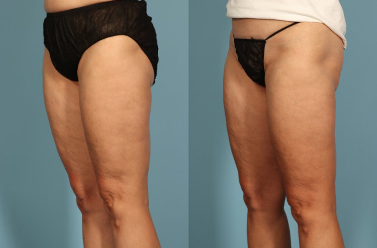 Thigh Lift Before & After Gallery - Patient 237274 - Image 4