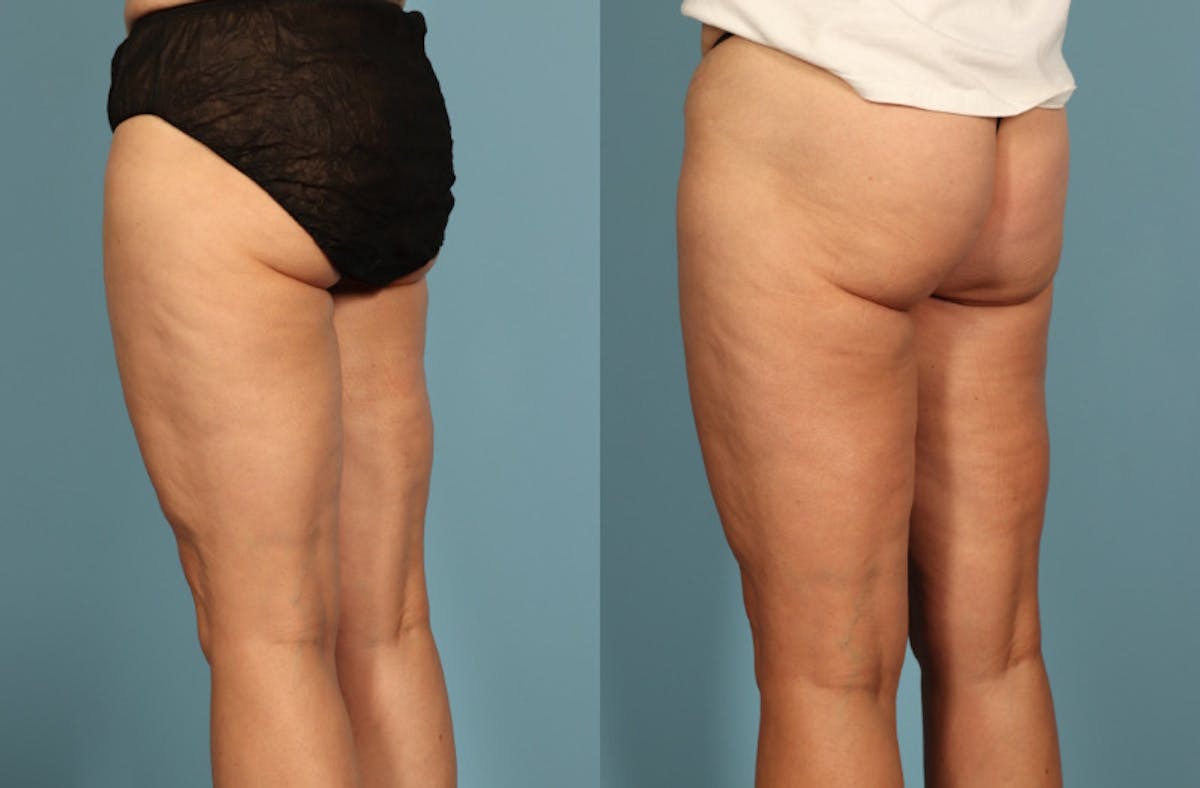 Thigh Lift Before & After Gallery - Patient 237274 - Image 5