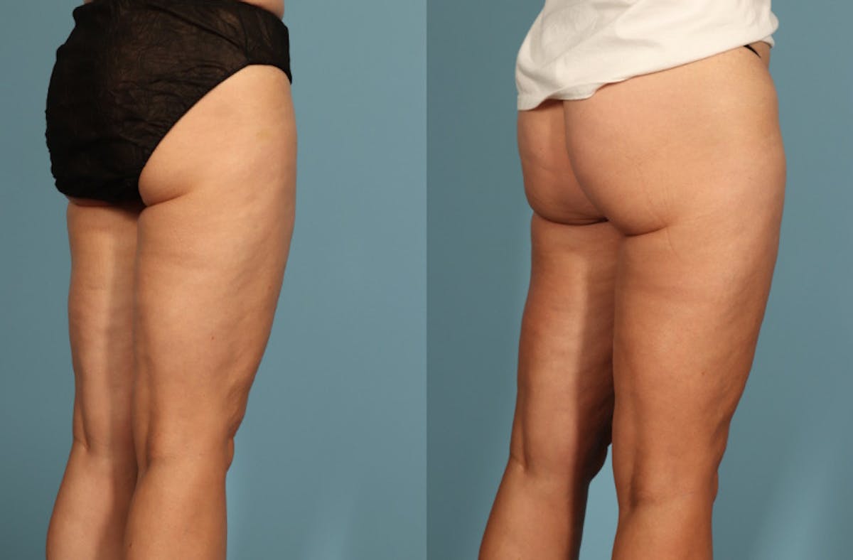 Thigh Lift Before & After Gallery - Patient 237274 - Image 6