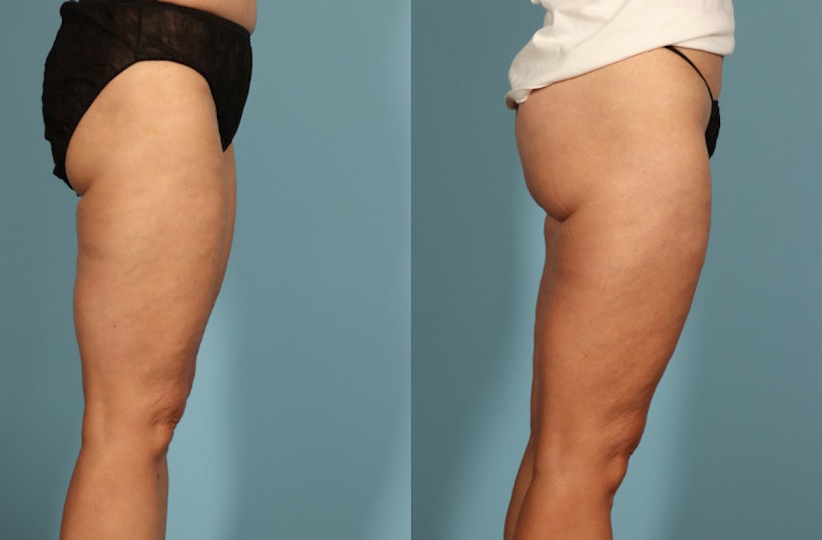 Thigh Lift Before & After Gallery - Patient 237274 - Image 7