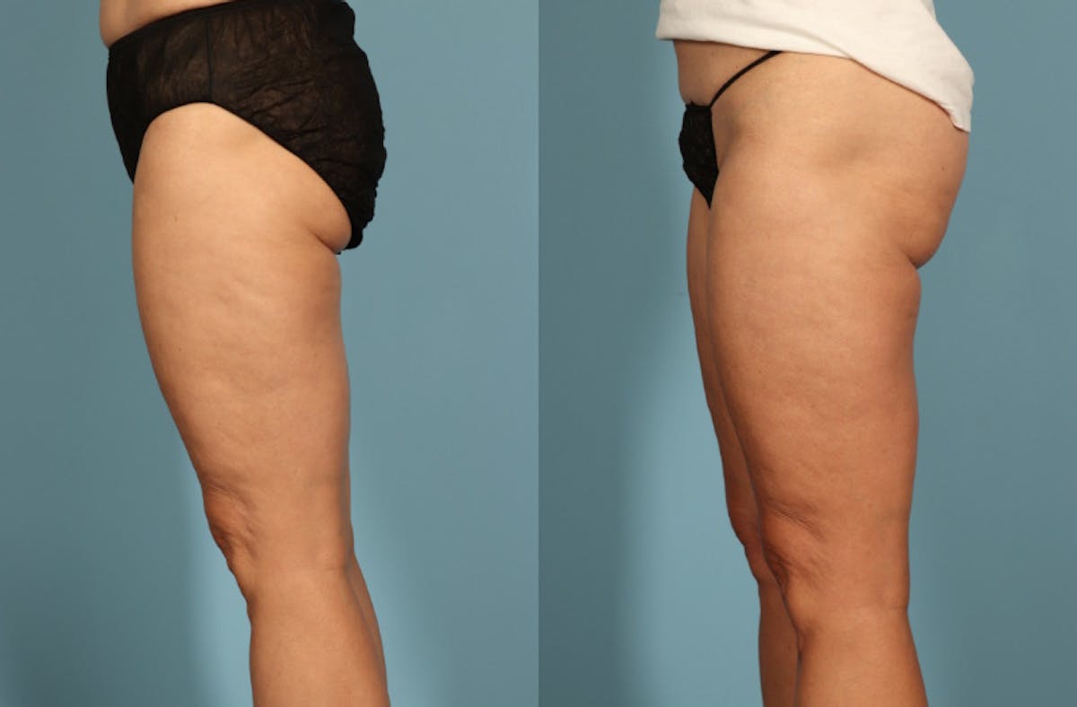 Thigh Lift Before & After Gallery - Patient 237274 - Image 8