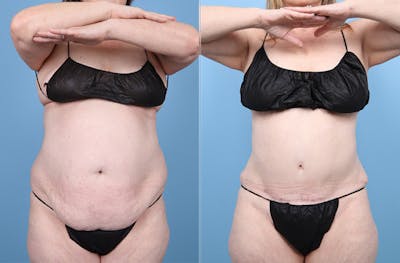 Tummy Tuck Before & After Gallery - Patient 220946 - Image 1