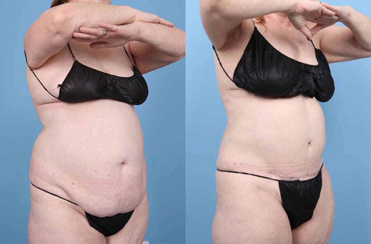 Tummy Tuck Before & After Gallery - Patient 220946 - Image 2
