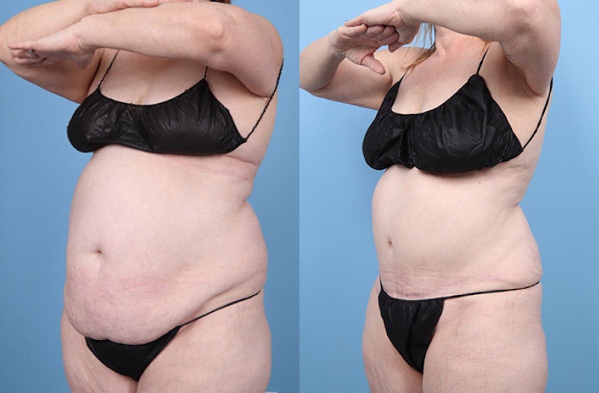 Tummy Tuck Before & After Gallery - Patient 220946 - Image 3