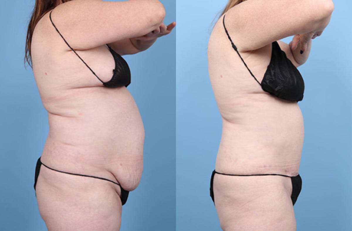 Tummy Tuck Before & After Gallery - Patient 220946 - Image 4