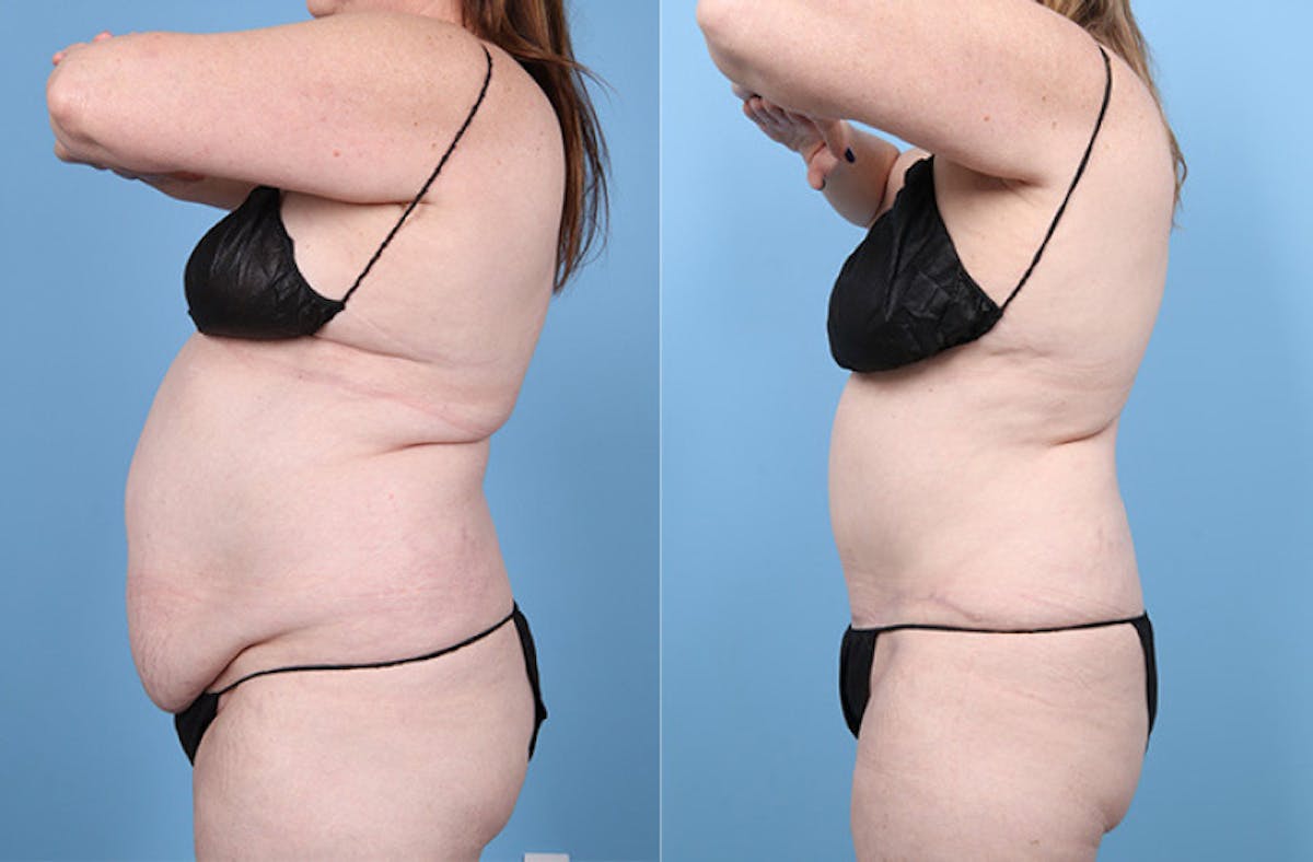 Tummy Tuck Before & After Gallery - Patient 220946 - Image 5