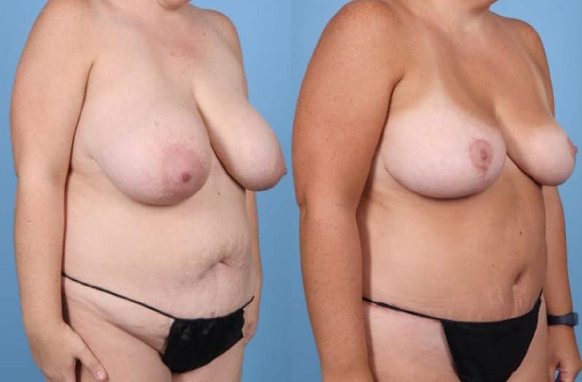Mommy Makeover Before & After Gallery - Patient 286241 - Image 2