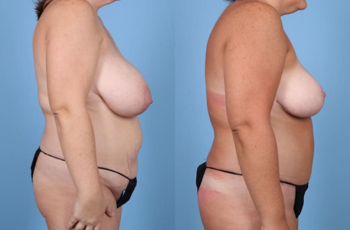 Mommy Makeover Before & After Gallery - Patient 286241 - Image 4