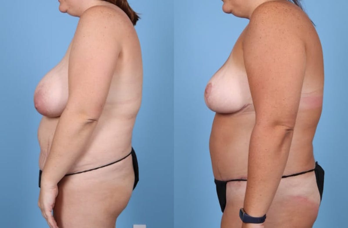 Mommy Makeover Before & After Gallery - Patient 286241 - Image 5