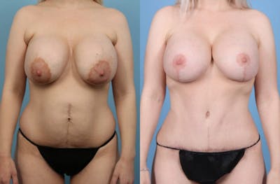 Mommy Makeover Before & After Gallery - Patient 329199 - Image 1