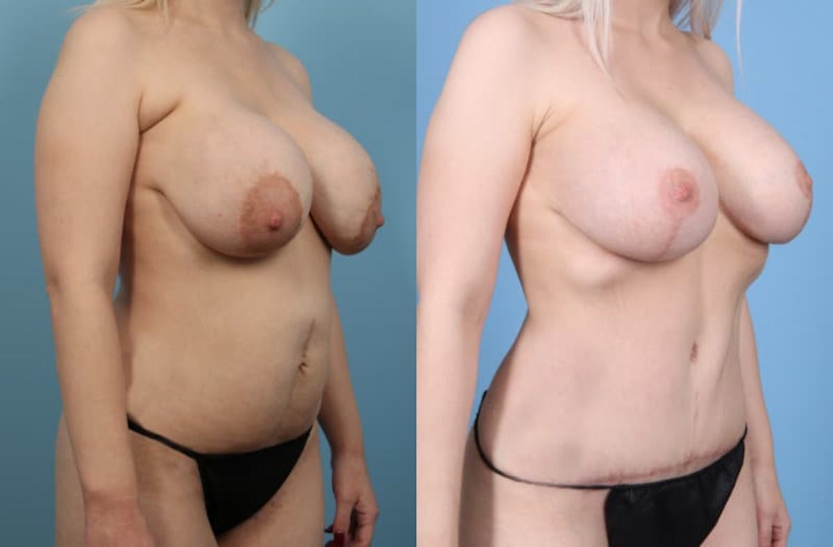 Mommy Makeover Before & After Gallery - Patient 329199 - Image 3