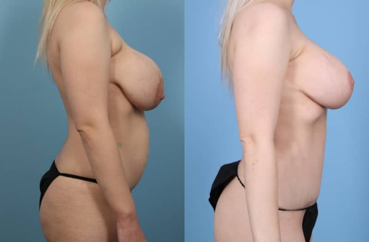 Mommy Makeover Before & After Gallery - Patient 329199 - Image 4