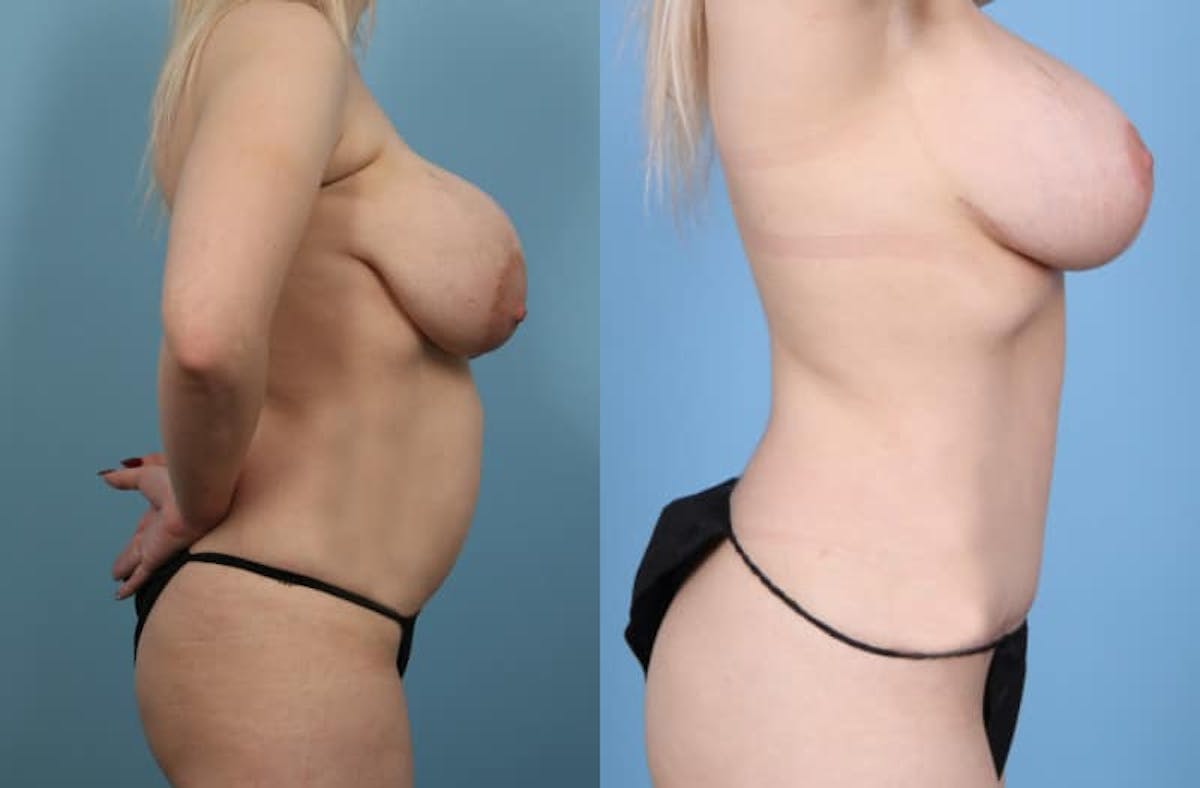 Mommy Makeover Before & After Gallery - Patient 329199 - Image 7