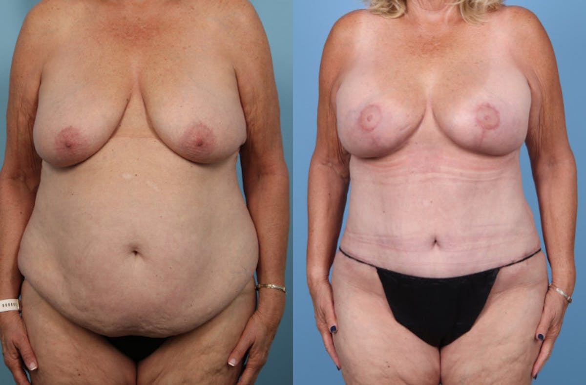 Mommy Makeover Before & After Gallery - Patient 341518 - Image 1
