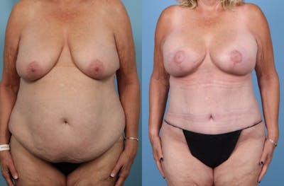 Mommy Makeover Before & After Gallery - Patient 341518 - Image 1