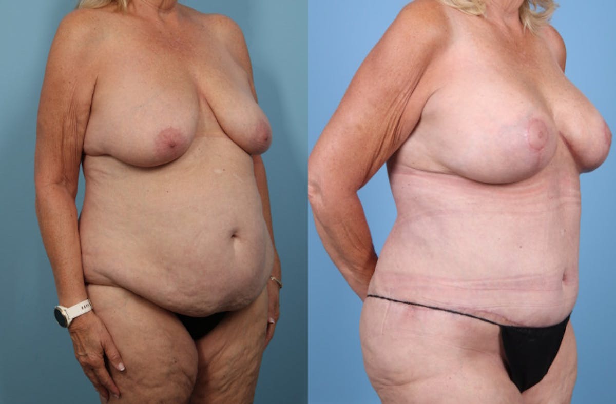 Mommy Makeover Before & After Gallery - Patient 341518 - Image 2