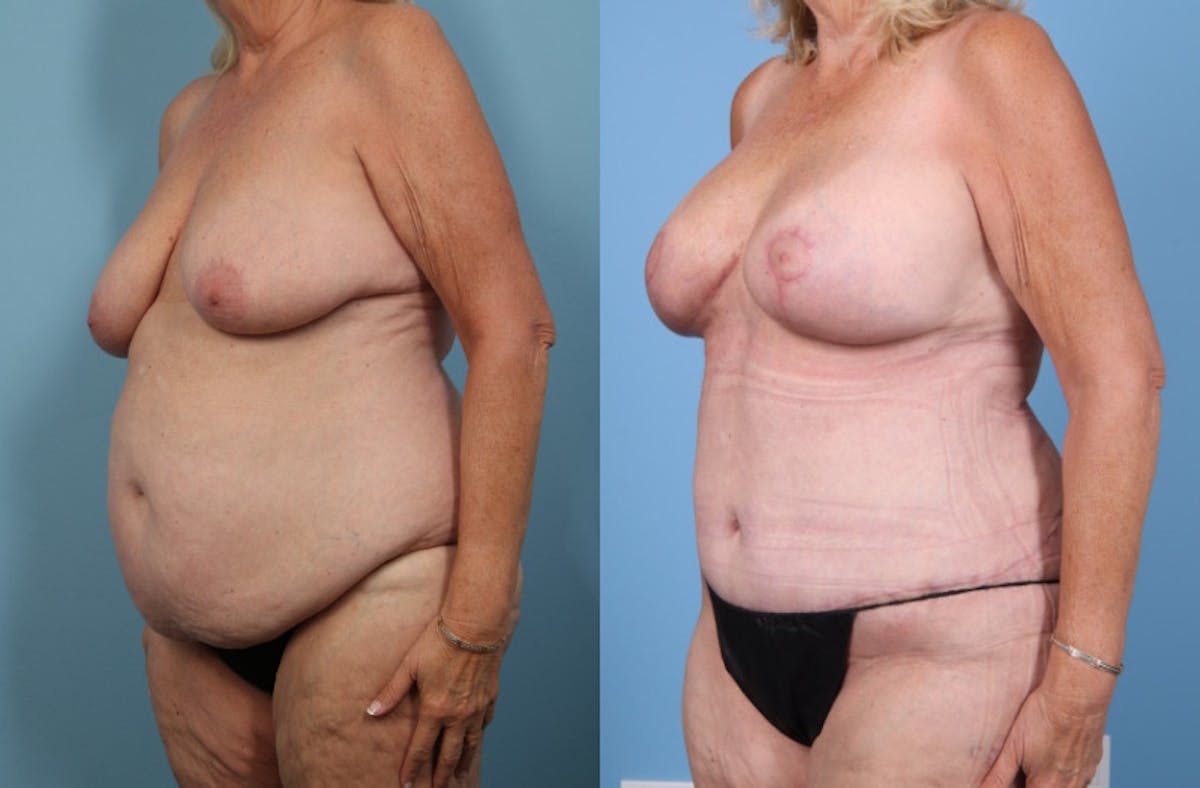 Mommy Makeover Before & After Gallery - Patient 341518 - Image 3