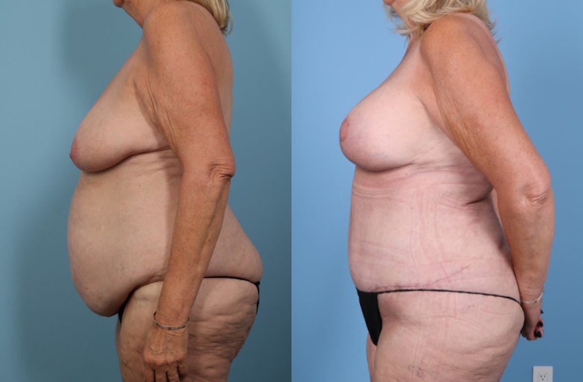 Mommy Makeover Before & After Gallery - Patient 341518 - Image 4