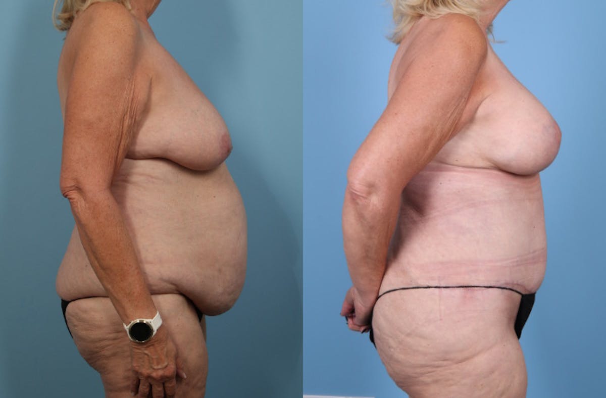 Mommy Makeover Before & After Gallery - Patient 341518 - Image 5