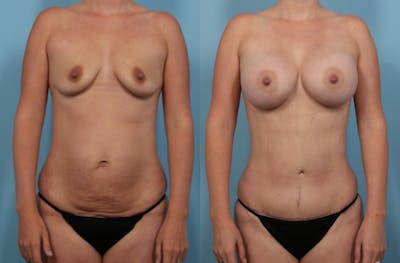 Mommy Makeover Before & After Gallery - Patient 403186 - Image 1