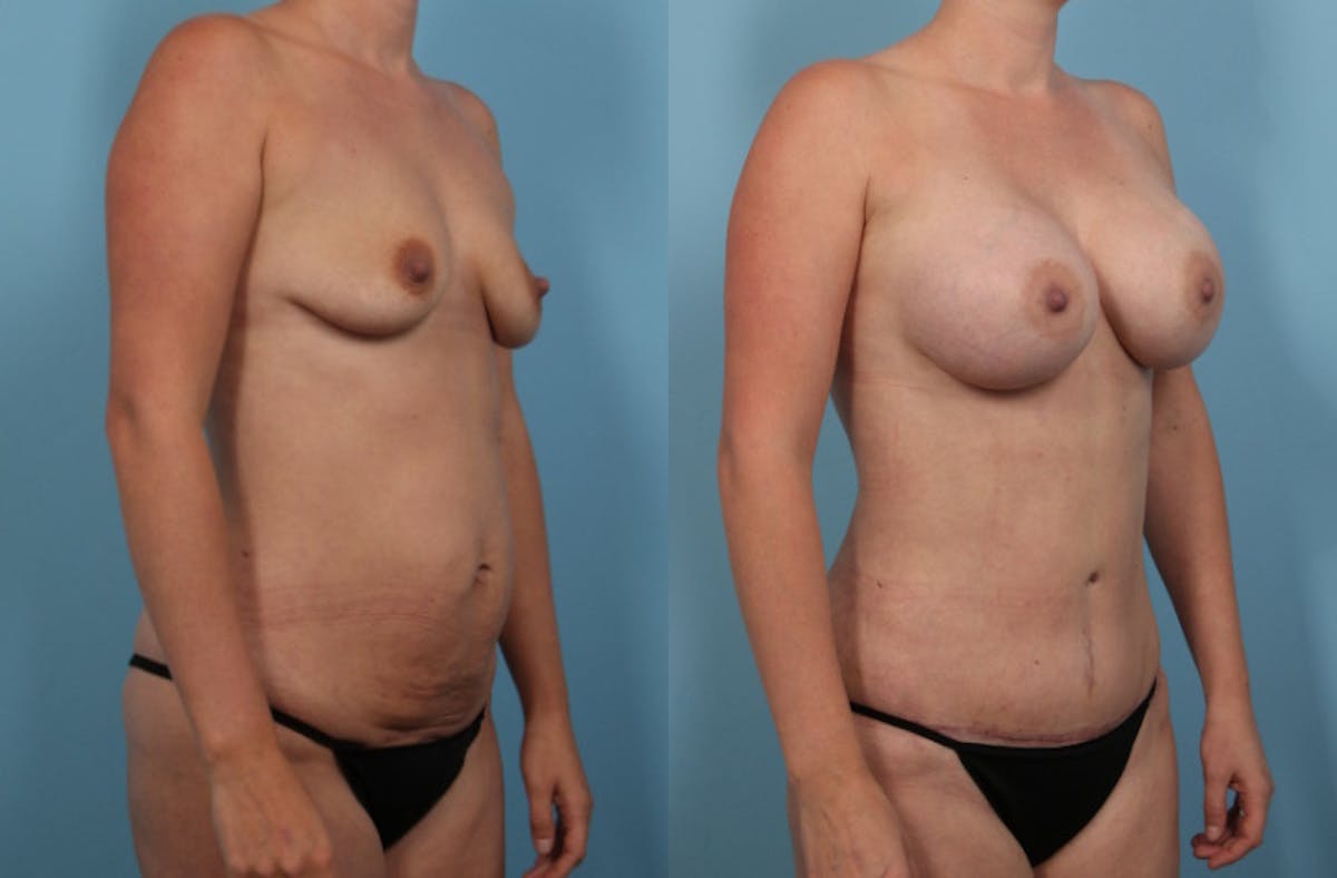 Mommy Makeover Before & After Gallery - Patient 403186 - Image 2