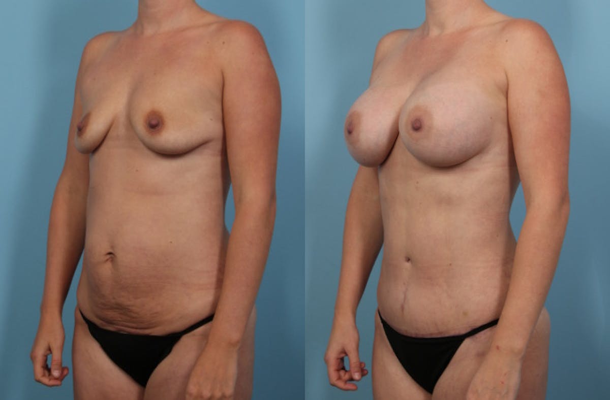 Mommy Makeover Before & After Gallery - Patient 403186 - Image 3