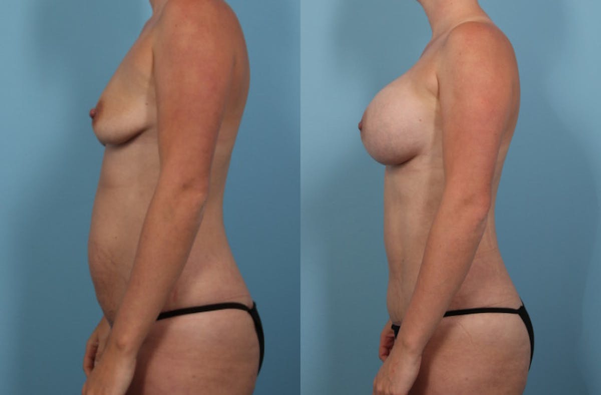 Mommy Makeover Before & After Gallery - Patient 403186 - Image 4