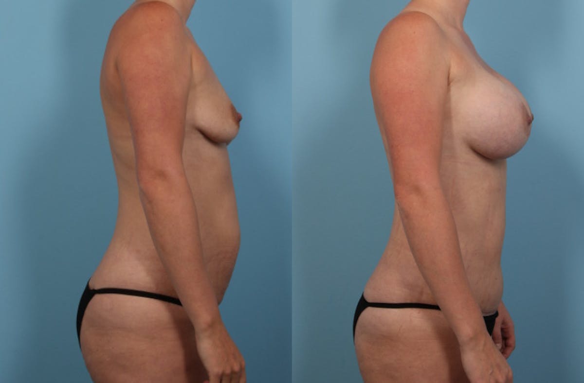 Mommy Makeover Before & After Gallery - Patient 403186 - Image 5