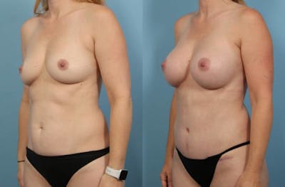 Mommy Makeover Before & After Gallery - Patient 326537 - Image 1