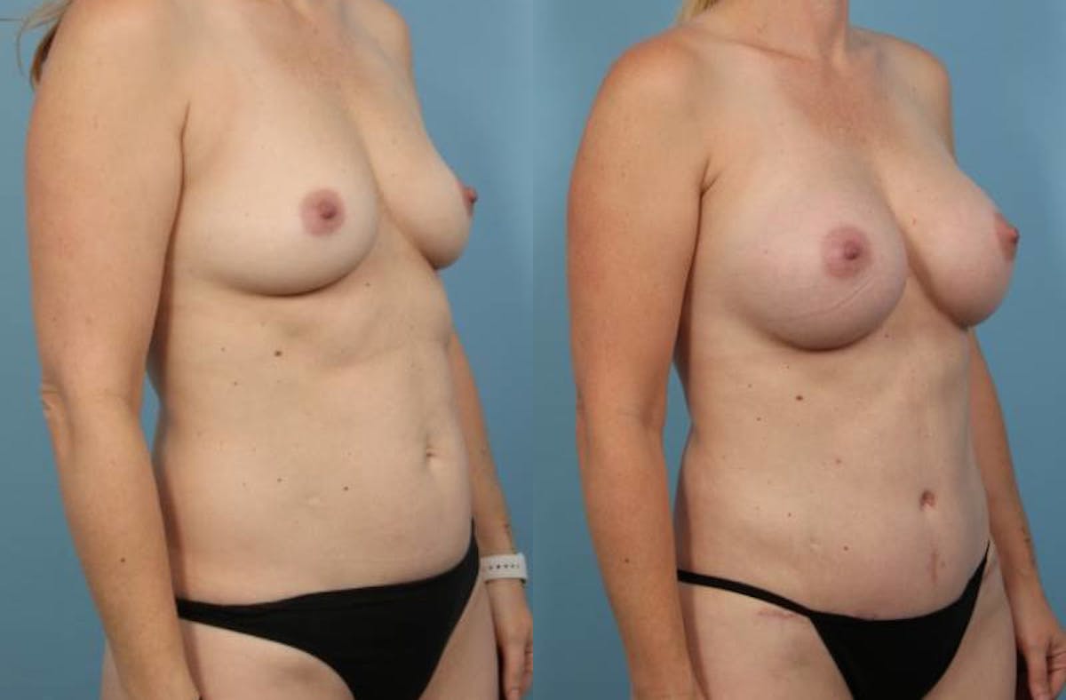 Mommy Makeover Before & After Gallery - Patient 326537 - Image 2