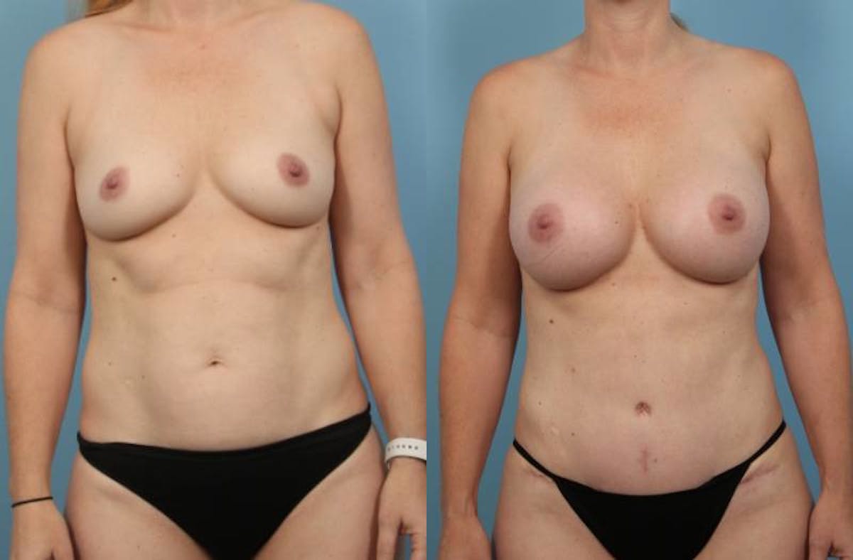 Mommy Makeover Before & After Gallery - Patient 326537 - Image 3
