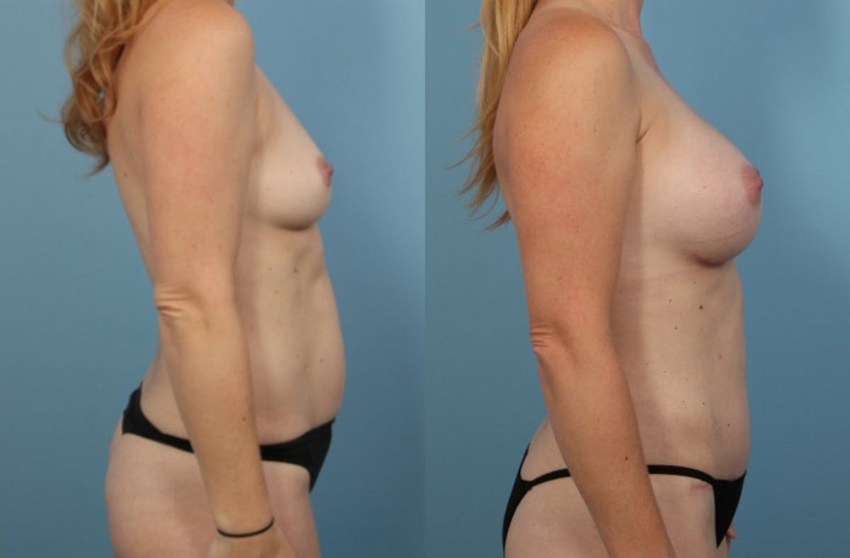Mommy Makeover Before & After Gallery - Patient 326537 - Image 4