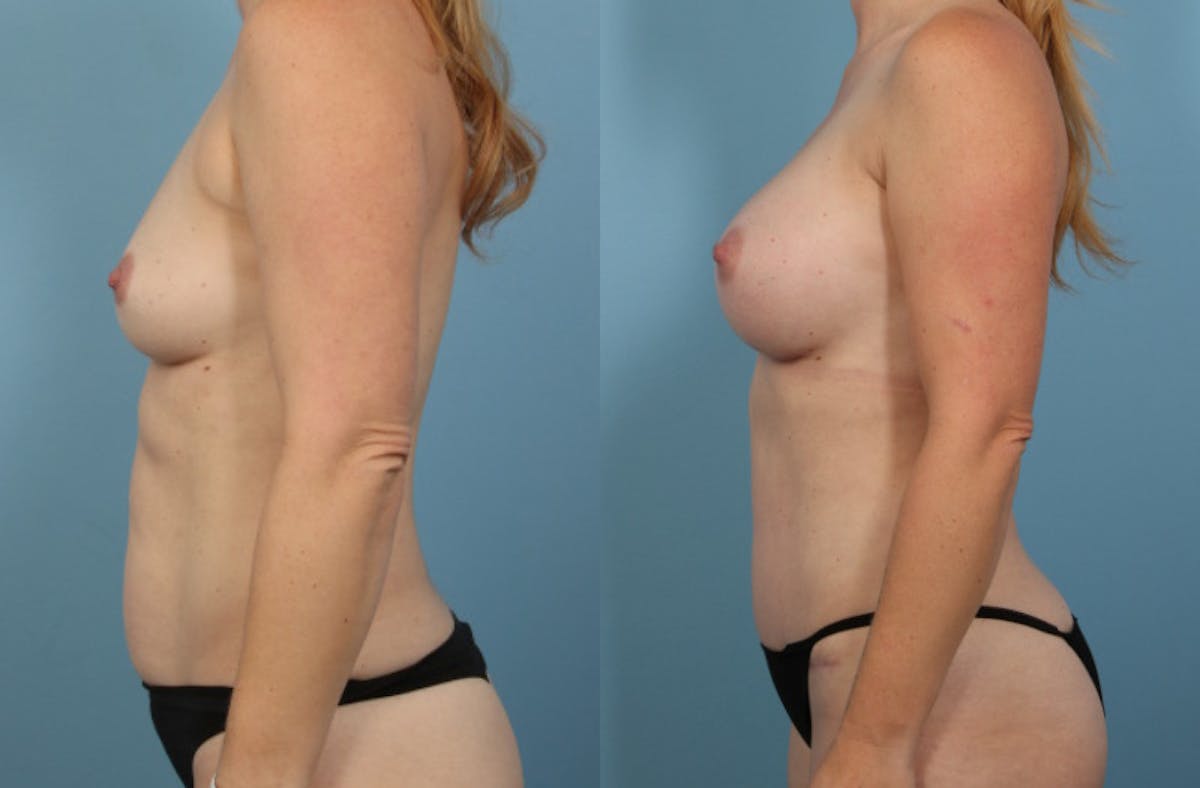 Mommy Makeover Before & After Gallery - Patient 326537 - Image 5