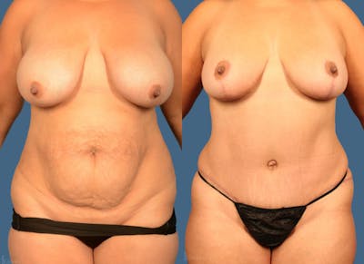 Mommy Makeover Before & After Gallery - Patient 539246 - Image 1
