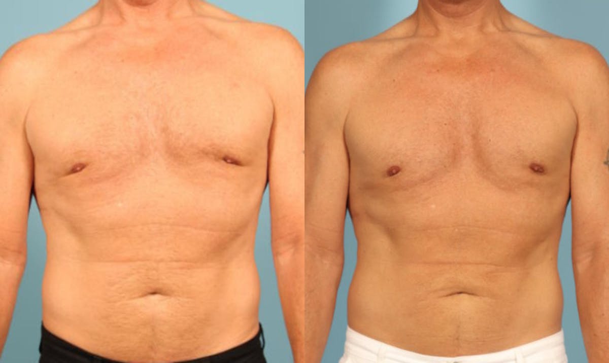 Fat Grafting Before & After Gallery - Patient 288136 - Image 1