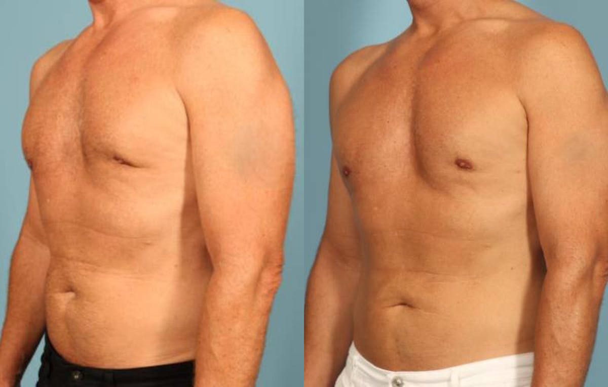 Fat Grafting Before & After Gallery - Patient 288136 - Image 2