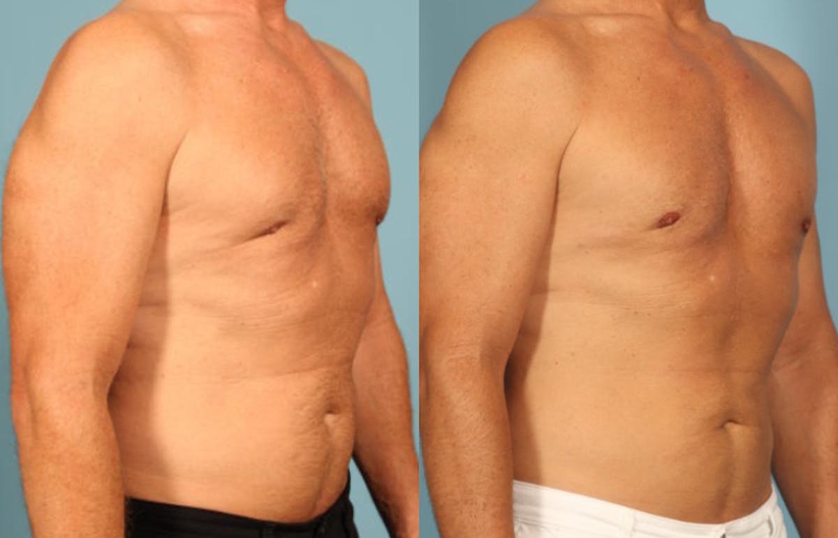 Fat Grafting Before & After Gallery - Patient 288136 - Image 3