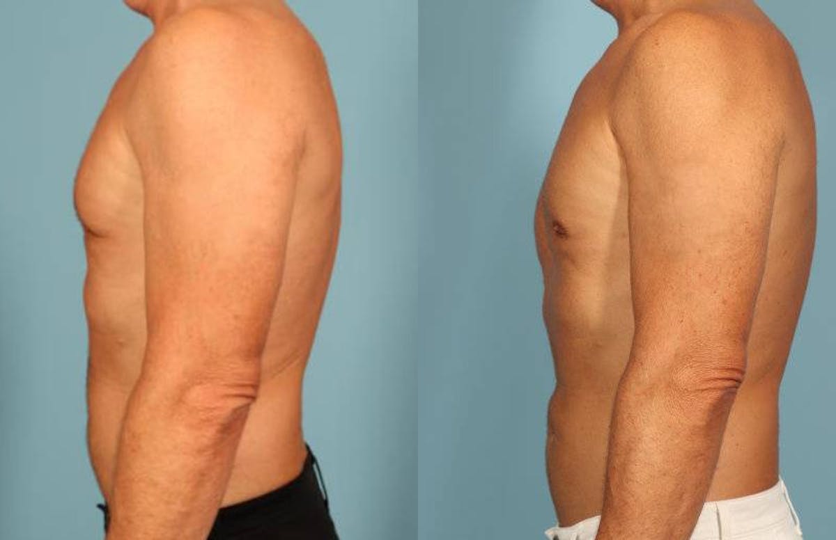 Fat Grafting Before & After Gallery - Patient 288136 - Image 4