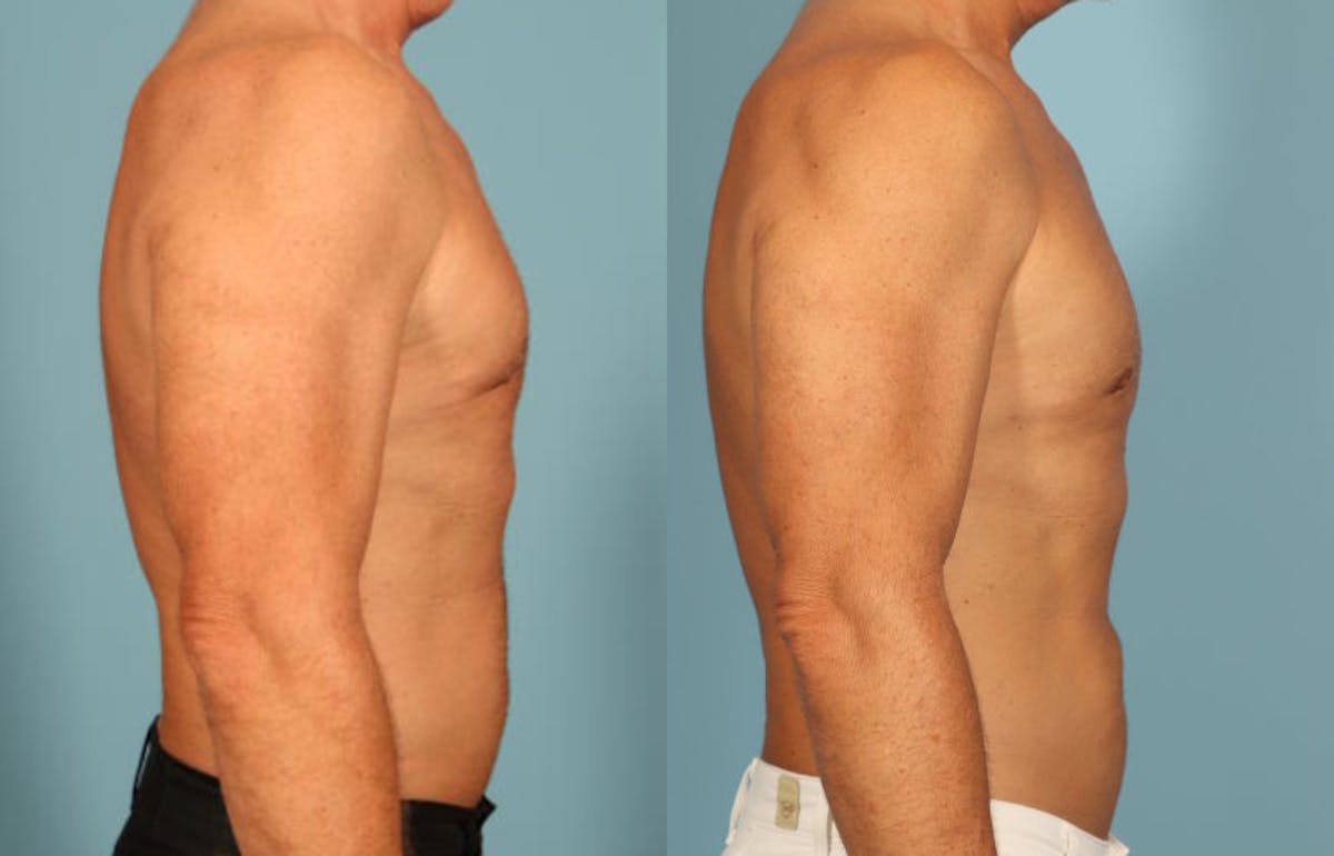 Fat Grafting Before & After Gallery - Patient 288136 - Image 5