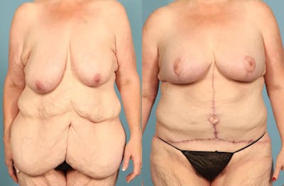 Weight Loss Body Contouring Before & After Gallery - Patient 203186 - Image 1