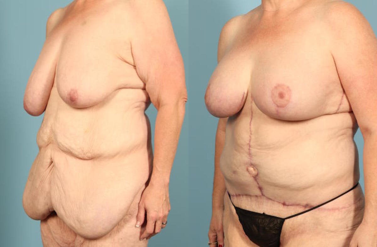 Weight Loss Body Contouring Before & After Gallery - Patient 203186 - Image 2
