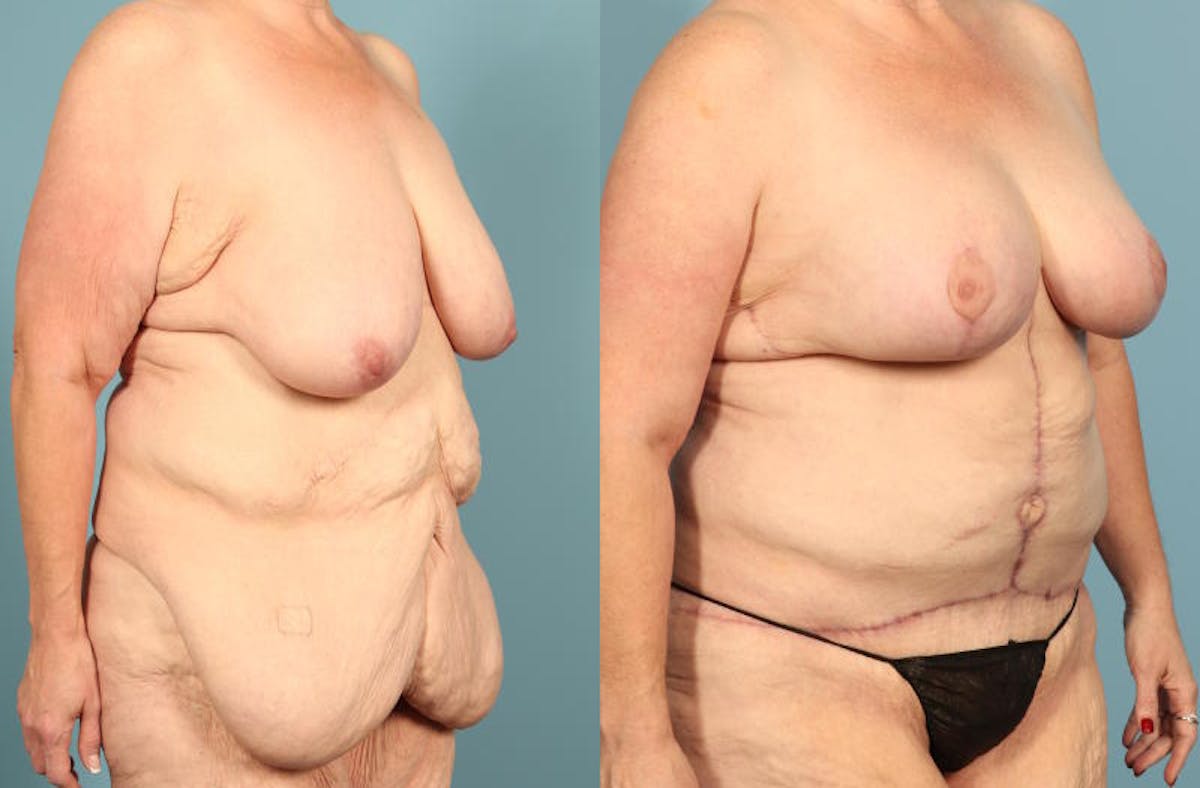 Weight Loss Body Contouring Before & After Gallery - Patient 203186 - Image 3