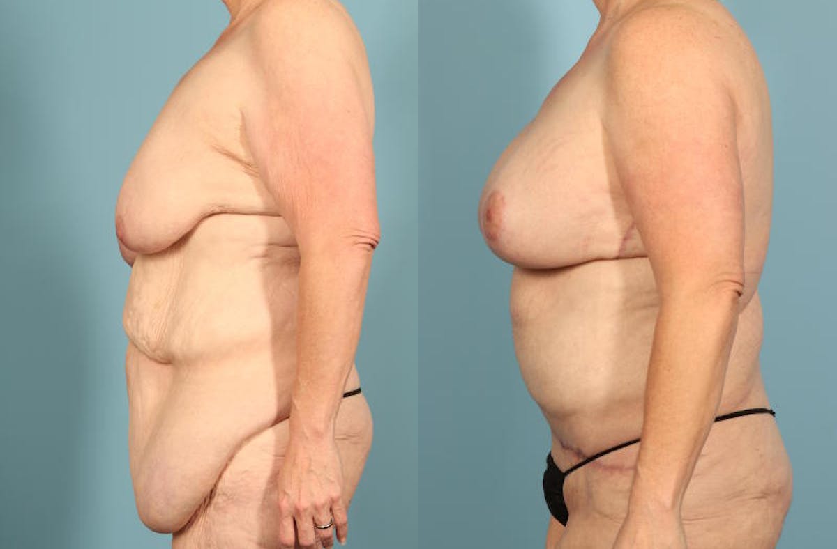 Weight Loss Body Contouring Before & After Gallery - Patient 203186 - Image 4